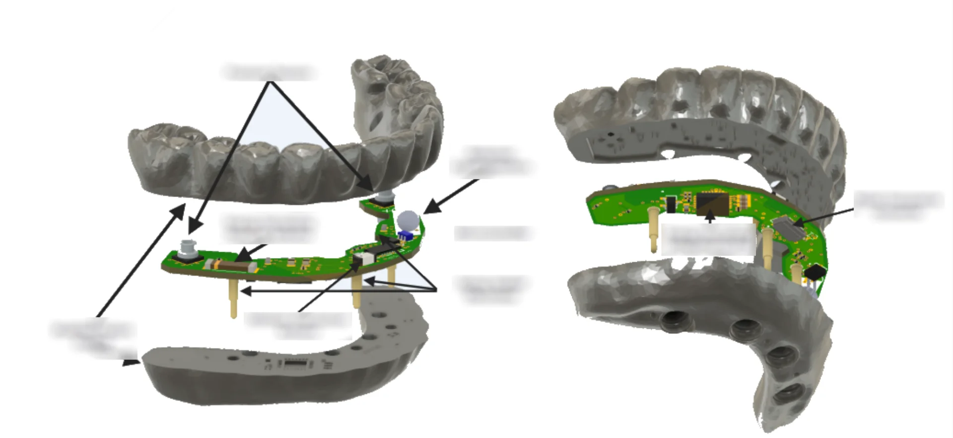 Elecromechanical Integration and Optimization for Dental Implants